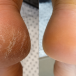 Calcanhares Rachados NUNCA MAIS! O Elixir Caseiro que Deixa Seus Pés Macios como os de Bebê!